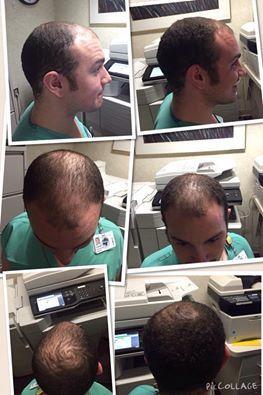 Male Pattern Baldness